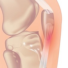 Jumper’s Knee: My personal treatment of Patellar Tendonitis